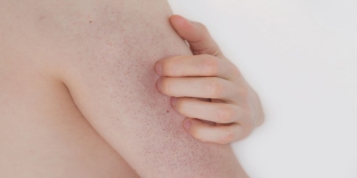 کراتوز پیلاریس یا پوست مرغی (Keratosis pilaris)