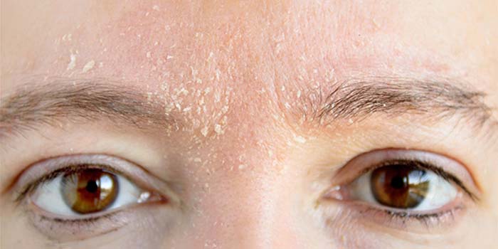 درماتیت سبورئیک ، علایم ، علل و درمان آن چیست؟