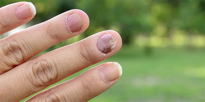 علائم قارچ ناخن بعد از کاشت ناخن