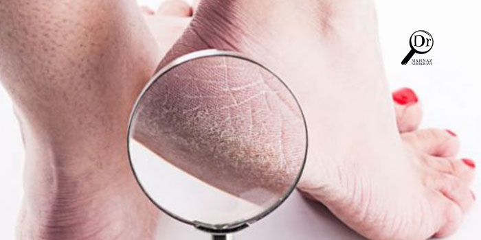 بررسی علت ترک پا و نحوه درمان آن