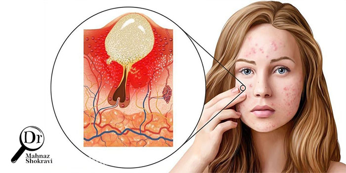 علل و راههای درمان جوشهای زیر پوستی چیست؟
