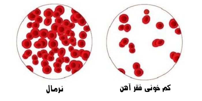 برای کم خونی فقر آهن چی خوبه؟!
