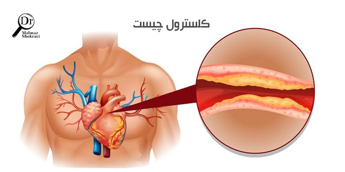 علائم کلسترول بالا چیست ؟