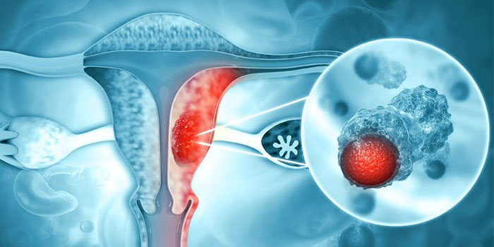 سرطان دهانه رحم و نقشHPV