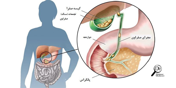 سنگ کیسه صفرا چیست،علائم و درمان آن چگونه است؟