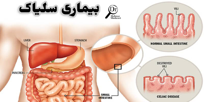 بیماری سلیاک چیست و چگونه تشخیص داده می شود؟