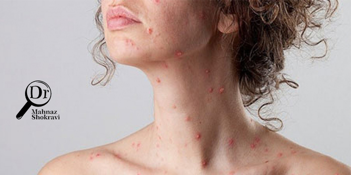 بیماری زونا چیست و چه علائمی دارد؟