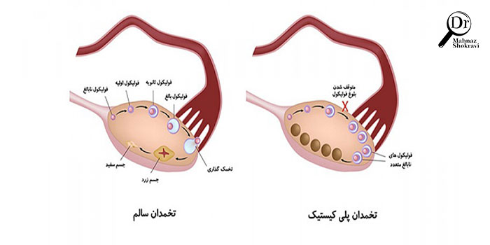 سندرم تخمدان پلی‌کیستیک چیست؟