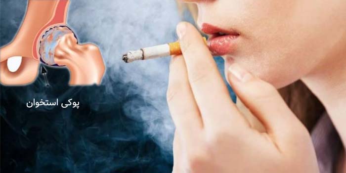 تاثیر سیگار بر پوکی استخوان