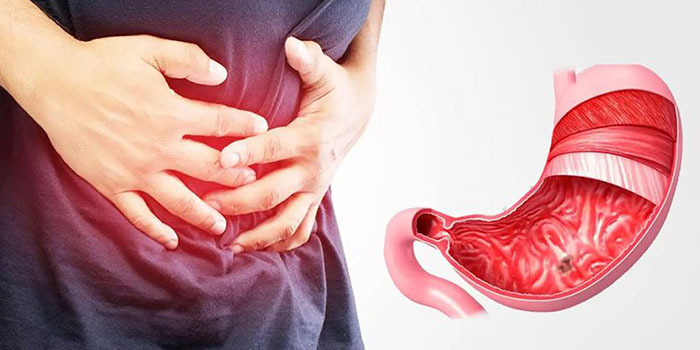 زخم معده چیست و چه علائمی دارد؟