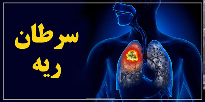 علائم سرطان ریه چیست و چه دلایل و درمان هایی دارد؟