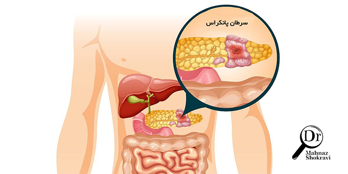 سرطان پانکراس (لوزالمعده) چیست و چه علائمی دارد؟