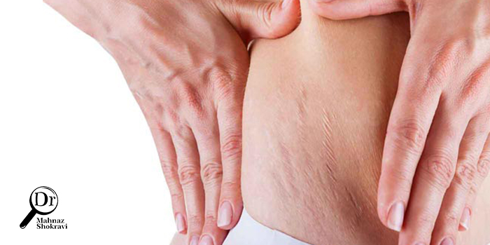 سندروم کوشینگ چیست و چه علائمی دارد؟