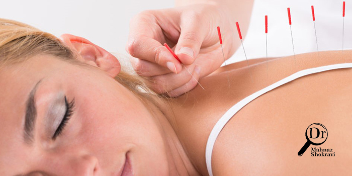 طب سوزنی در درمان چه بیماری هایی موثر است؟