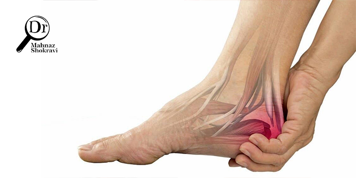 خار پاشنه چیست و چه علائمی دارد؟