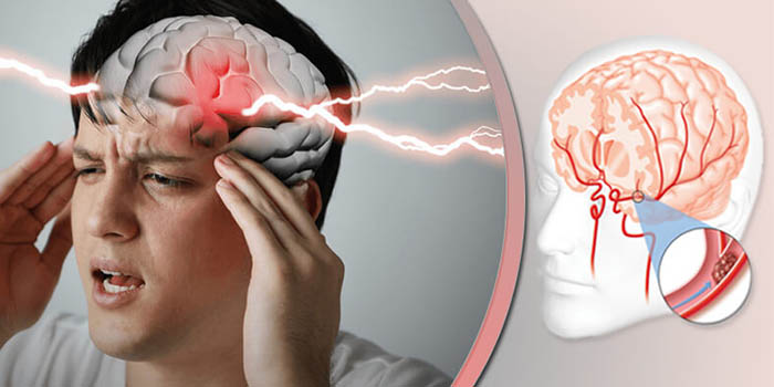 سکته مغزی چیست و چگونه اتفاق می افتد؟