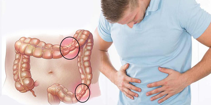 سندروم روده تحریک پذیر چیست؟